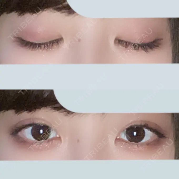 二重埋没 東京形成美容外科 船橋院 DAY 38 メイン用