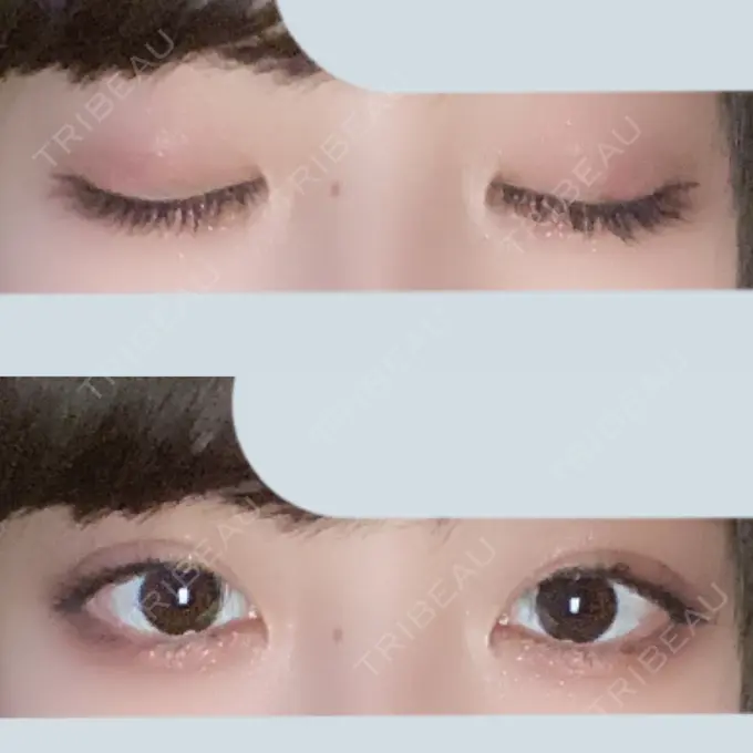 二重埋没 東京形成美容外科 船橋院 DAY 38 メイン用