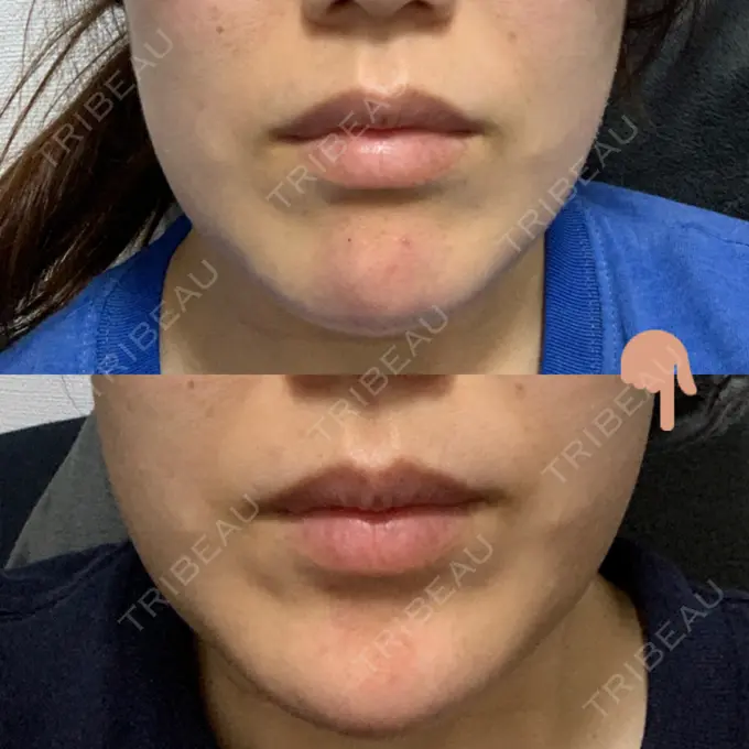 ボトックス（あご） TCB東京中央美容外科 心斎橋筋院 AFTER メイン用