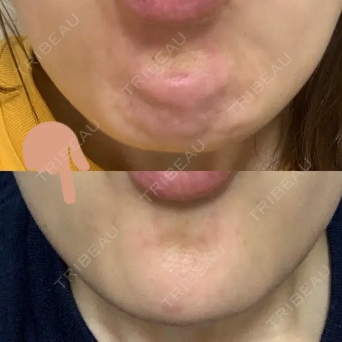 ボトックス（あご） TCB東京中央美容外科 心斎橋筋院 DAY 10 メイン用