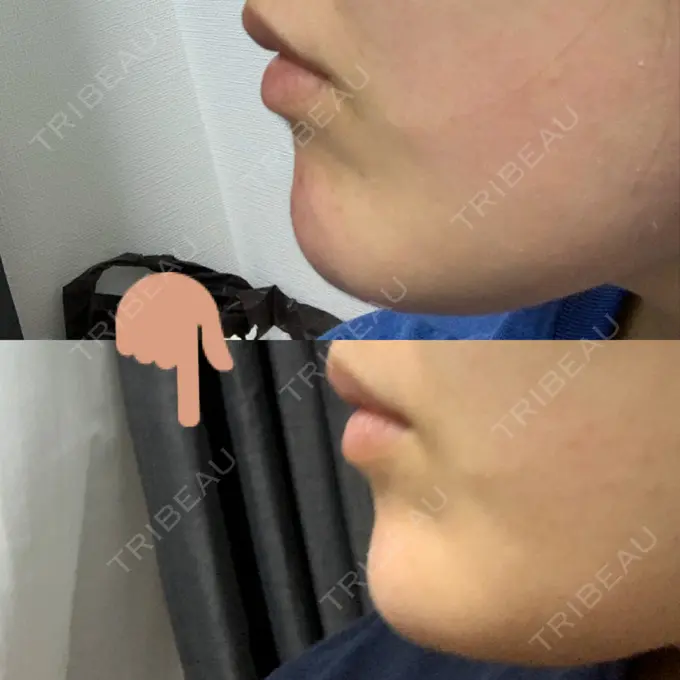 ボトックス（あご） TCB東京中央美容外科 心斎橋筋院 DAY 10 メイン用