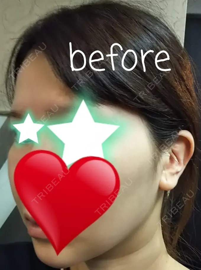 骨削り（頬） / 脂肪吸引（顔） RG整形外科（旧リオン整形外科） AFTER メイン用