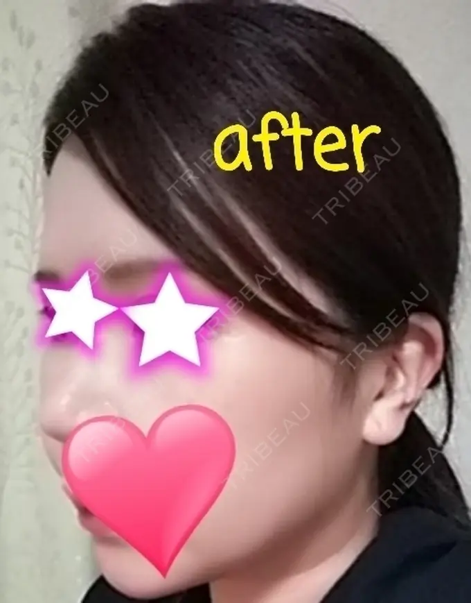 骨削り（頬） / 脂肪吸引（顔） RG整形外科（旧リオン整形外科） DAY 105 メイン用