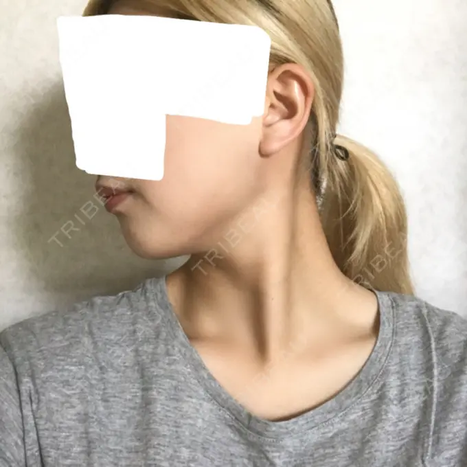 バッカルファット除去 / 脂肪吸引（顔） ジョウクリニック 大阪院 DAY 77 メイン用