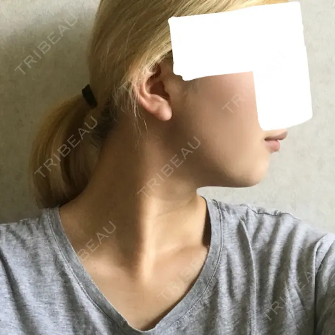 バッカルファット除去 / 脂肪吸引（顔） ジョウクリニック 大阪院 DAY 77 メイン用