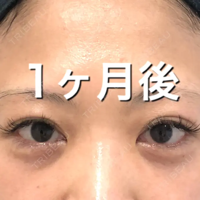 クマ治療 / タレ目形成・グラマラスライン（切開） / その他（目元） BIANCA銀座 DAY 30 メイン用