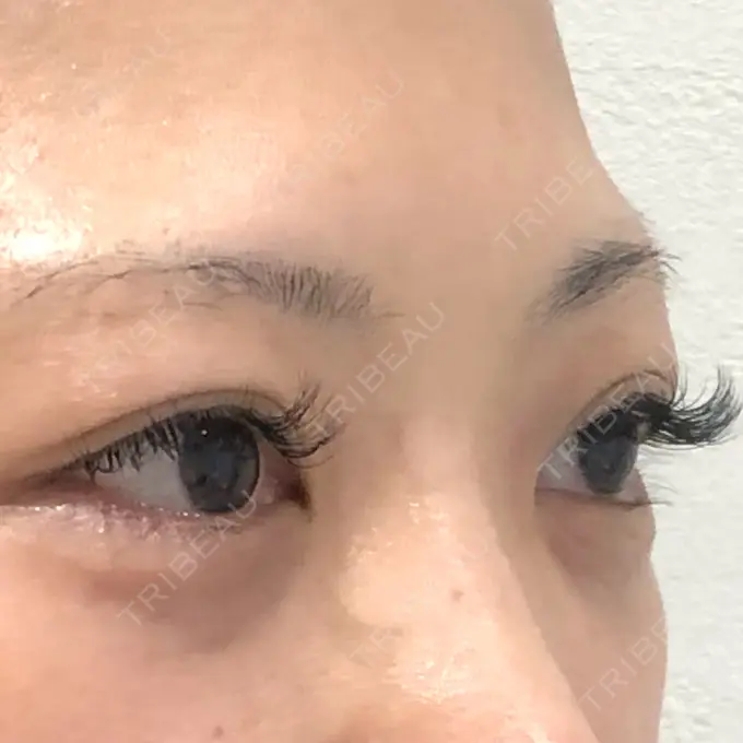 クマ治療 / タレ目形成・グラマラスライン（切開） / その他（目元） BIANCA銀座 DAY 30 メイン用