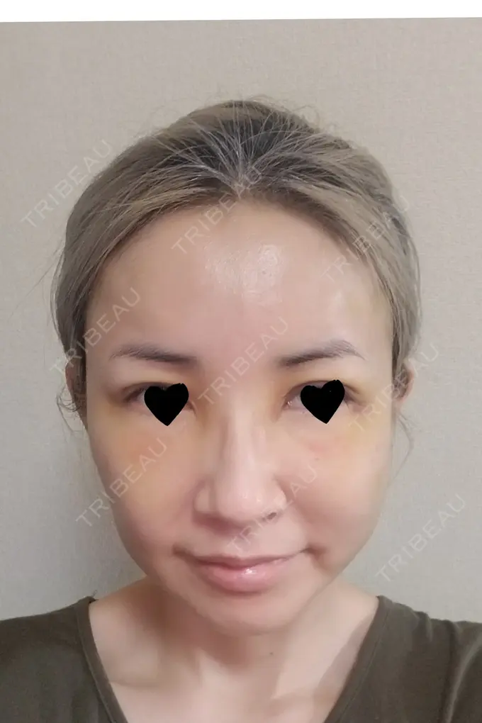 二重埋没 / 糸リフト / クマ治療 / 額を丸く / 下まぶたたるみ取り / 下まぶたの脂肪取り / 脂肪注入（額） / 脂肪注入（輪郭） 湘南美容クリニック 自由が丘院 DAY 6 メイン用