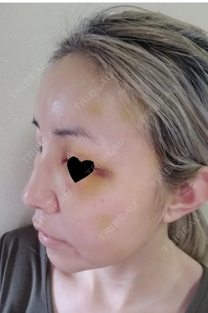 二重埋没 / 糸リフト / クマ治療 / 額を丸く / 下まぶたたるみ取り / 下まぶたの脂肪取り / 脂肪注入（額） / 脂肪注入（輪郭） 湘南美容クリニック 自由が丘院 DAY 6 メイン用