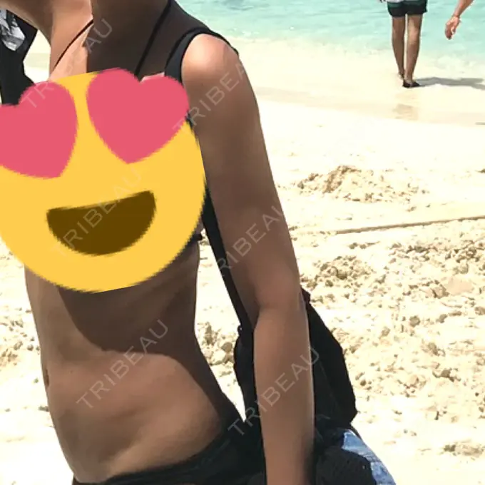 脂肪吸引（二の腕） / 脂肪吸引（お腹） ドクターフィット（Dr.fit）クリニック DAY 84 メイン用