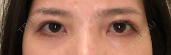 眼瞼下垂（切開） あきこクリニック DAY 47 メイン用