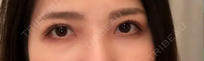 眼瞼下垂（切開） あきこクリニック DAY 47 メイン用