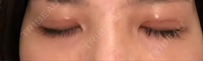 眼瞼下垂（切開） あきこクリニック DAY 47 メイン用