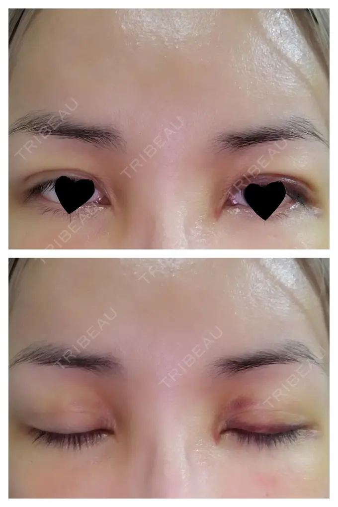 二重埋没 / 糸リフト / クマ治療 / 額を丸く / 下まぶたたるみ取り / 下まぶたの脂肪取り / 脂肪注入（額） / 脂肪注入（輪郭） 湘南美容クリニック 自由が丘院 DAY 8 メイン用