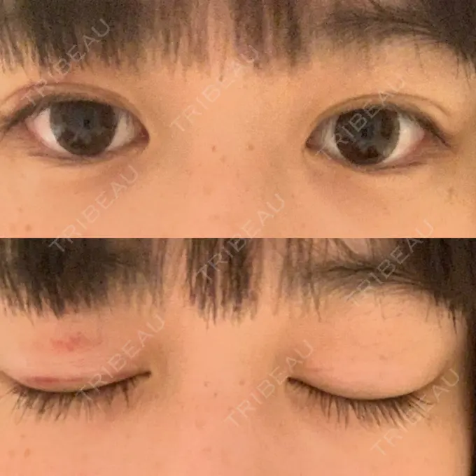 二重埋没 湘南美容クリニック 金沢院 DAY 16 メイン用