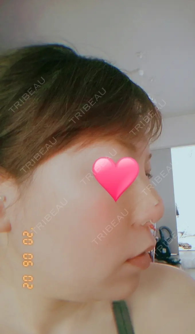 隆鼻術 品川スキンクリニック岡山院 DAY 0 メイン用