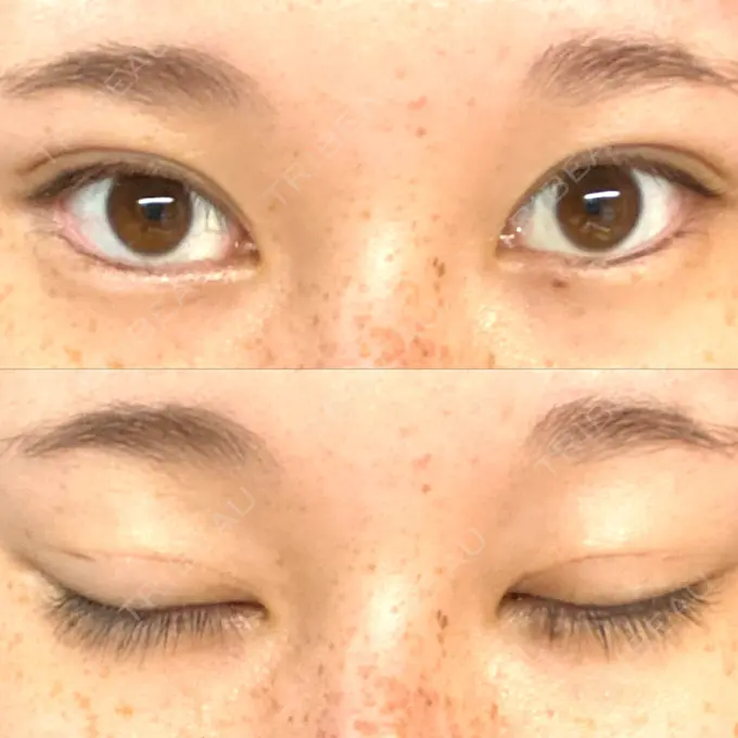 二重埋没 フェアクリニック川口 DAY 22 メイン用