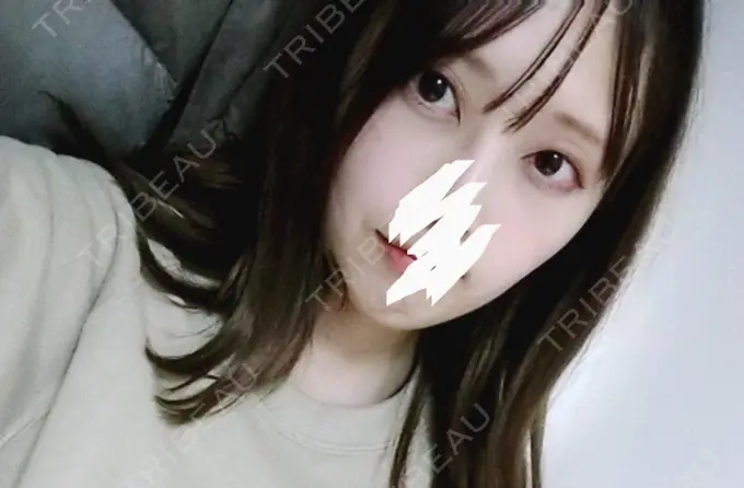 クマ治療 プラストクリニック AFTER メイン用