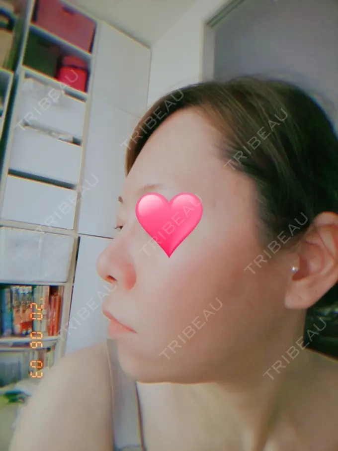 隆鼻術 品川スキンクリニック岡山院 AFTER メイン用