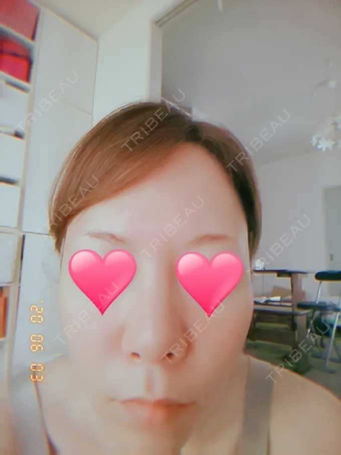 隆鼻術 品川スキンクリニック岡山院 DAY 1 メイン用