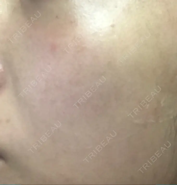 ほくろ・いぼ切除（肌） / ほくろ・いぼ除去レーザー（肌） / 美白レーザー / YAGレーザー REYOUNGクリニック DAY 12 メイン用