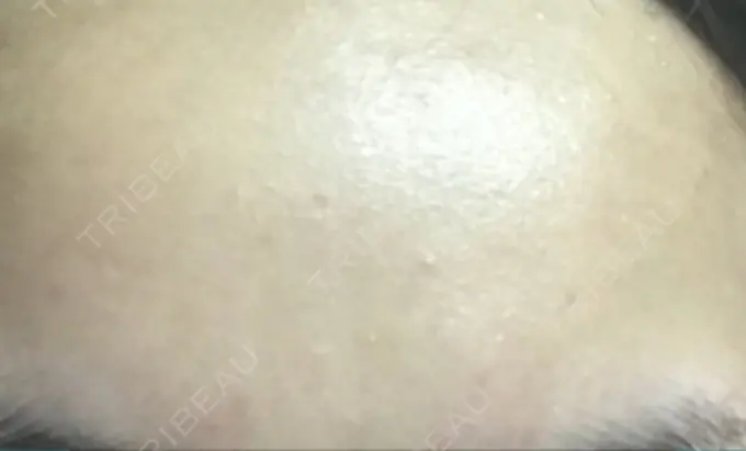 ほくろ・いぼ切除（肌） / ほくろ・いぼ除去レーザー（肌） / 美白レーザー / YAGレーザー REYOUNGクリニック DAY 12 メイン用