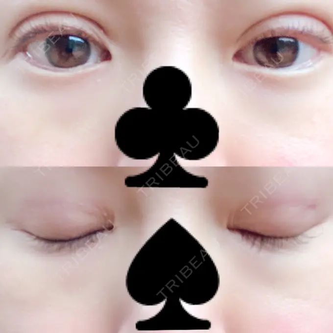 二重埋没 湘南美容クリニック 熊本院 DAY 1 メイン用