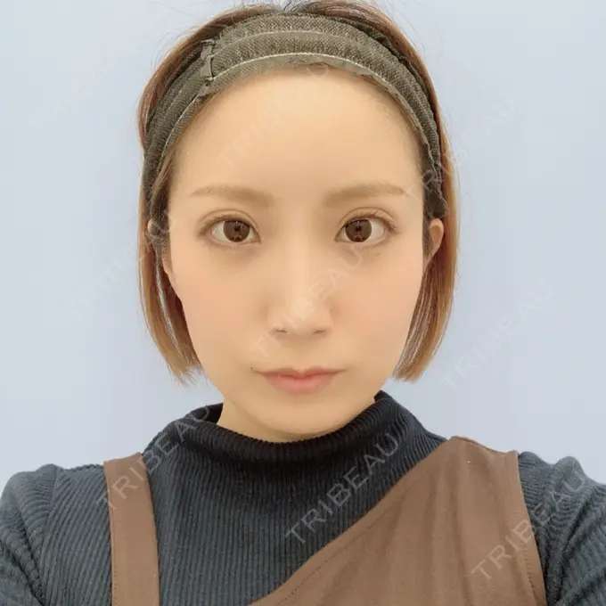 二重埋没 / 額を丸く / 下まぶたたるみ取り / 下まぶたの脂肪取り / 脂肪注入（肌） / 脂肪注入（額） / ボトックス（あご） 湘南美容クリニック 秋葉原院 AFTER メイン用