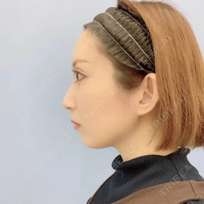 二重埋没 / 額を丸く / 下まぶたたるみ取り / 下まぶたの脂肪取り / 脂肪注入（肌） / 脂肪注入（額） / ボトックス（あご） 湘南美容クリニック 秋葉原院 DAY 101 メイン用