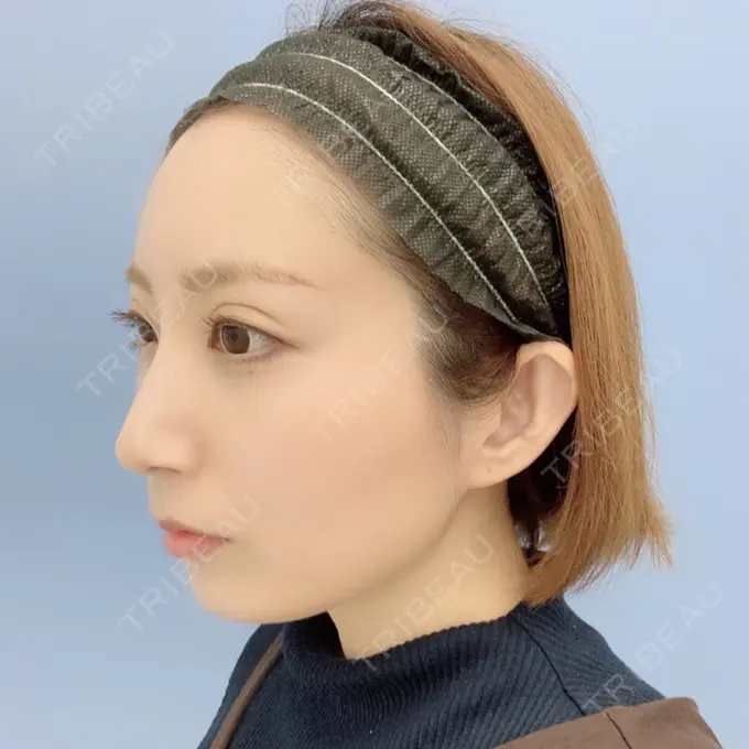 二重埋没 / 額を丸く / 下まぶたたるみ取り / 下まぶたの脂肪取り / 脂肪注入（肌） / 脂肪注入（額） / ボトックス（あご） 湘南美容クリニック 秋葉原院 DAY 101 メイン用