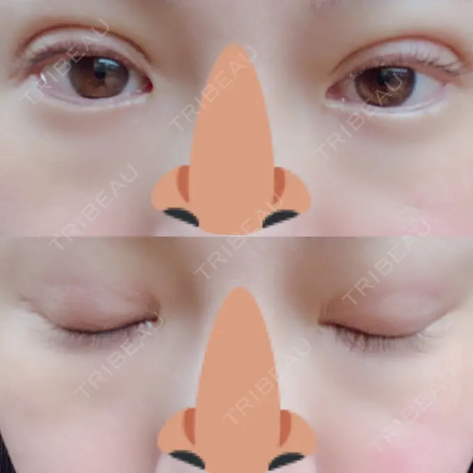 二重埋没 湘南美容クリニック 熊本院 DAY 2 メイン用