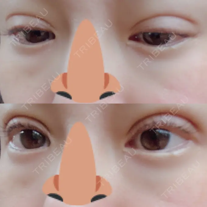 二重埋没 湘南美容クリニック 熊本院 DAY 2 メイン用