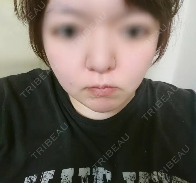 脂肪冷却（輪郭） 湘南美容クリニック 町田院 DAY 9 メイン用