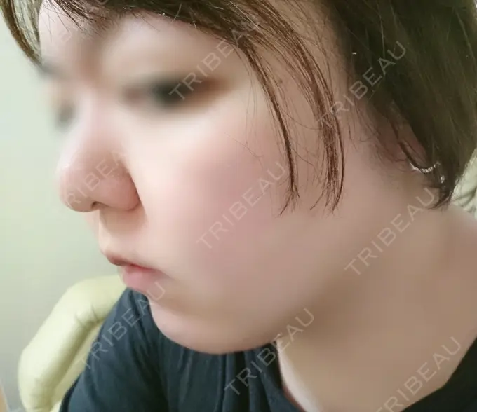 脂肪冷却（輪郭） 湘南美容クリニック 町田院 DAY 9 メイン用