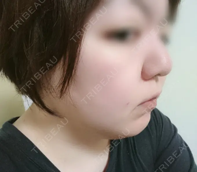 脂肪冷却（輪郭） 湘南美容クリニック 町田院 DAY 9 メイン用