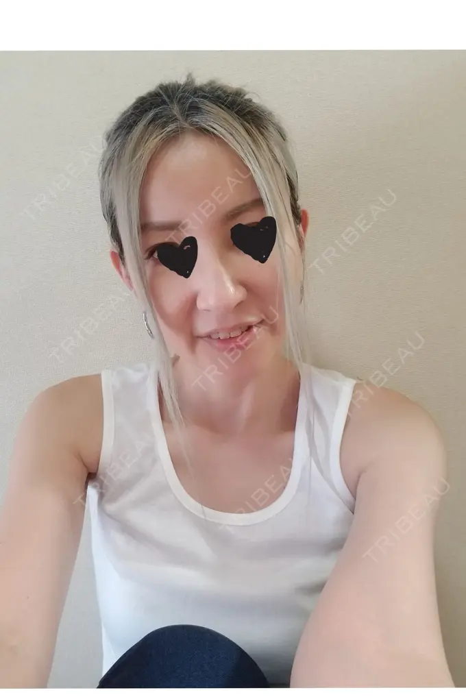 二重埋没 / 糸リフト / クマ治療 / 額を丸く / 下まぶたたるみ取り / 下まぶたの脂肪取り / 脂肪注入（額） / 脂肪注入（輪郭） 湘南美容クリニック 自由が丘院 DAY 11 メイン用