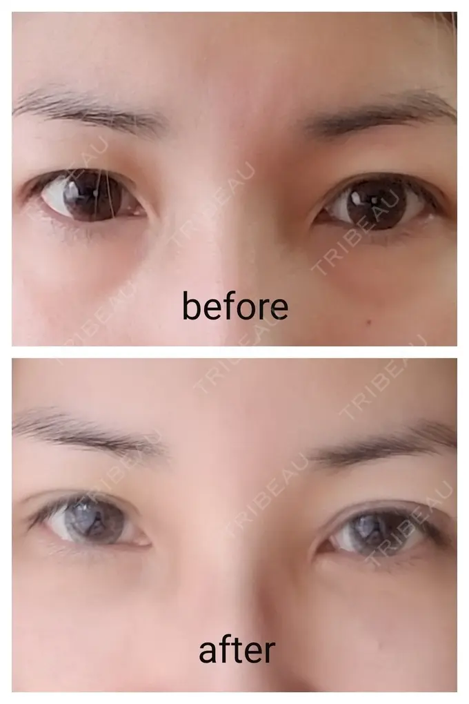 二重埋没 / 糸リフト / クマ治療 / 額を丸く / 下まぶたたるみ取り / 下まぶたの脂肪取り / 脂肪注入（額） / 脂肪注入（輪郭） 湘南美容クリニック 自由が丘院 DAY 11 メイン用