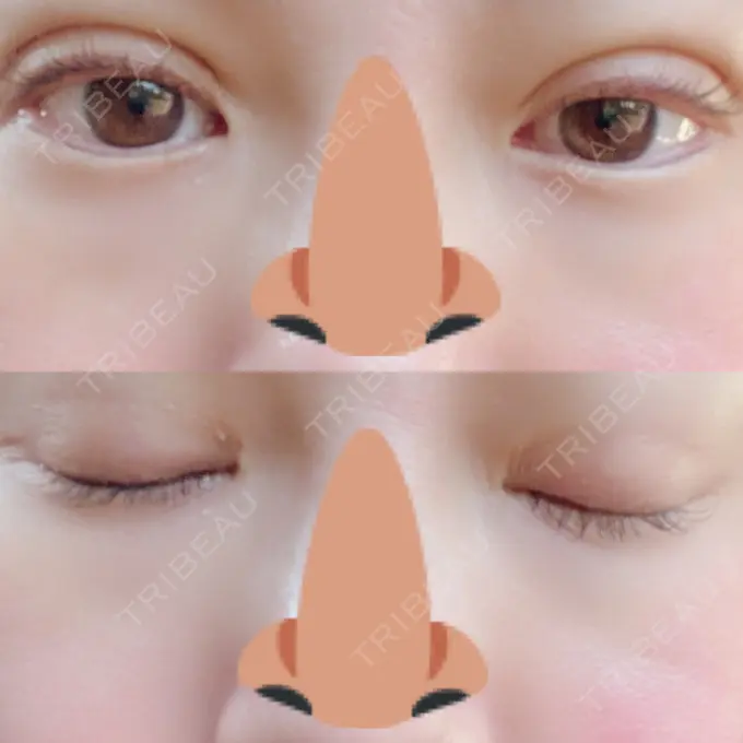 二重埋没 湘南美容クリニック 熊本院 DAY 3 メイン用