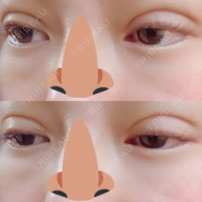 二重埋没 湘南美容クリニック 熊本院 DAY 3 メイン用