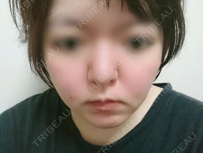 脂肪冷却（輪郭） 湘南美容クリニック 町田院 DAY 10 メイン用