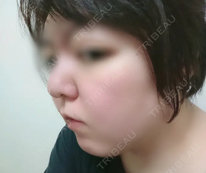 脂肪冷却（輪郭） 湘南美容クリニック 町田院 DAY 10 メイン用