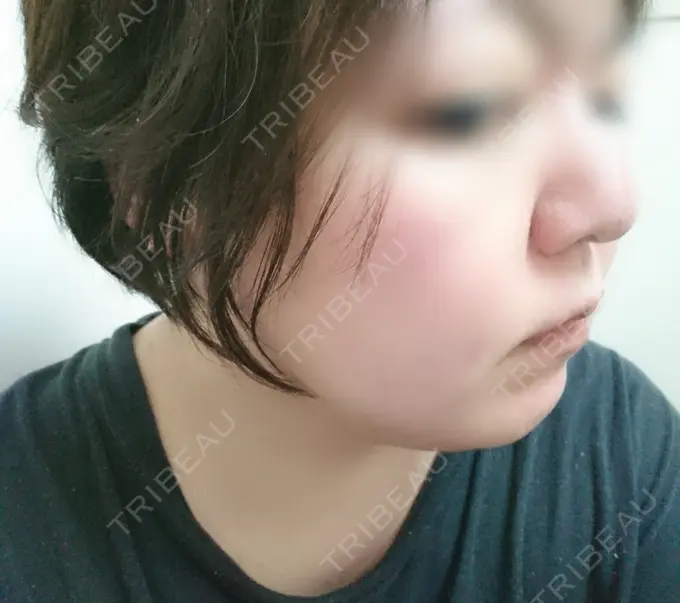 脂肪冷却（輪郭） 湘南美容クリニック 町田院 DAY 10 メイン用