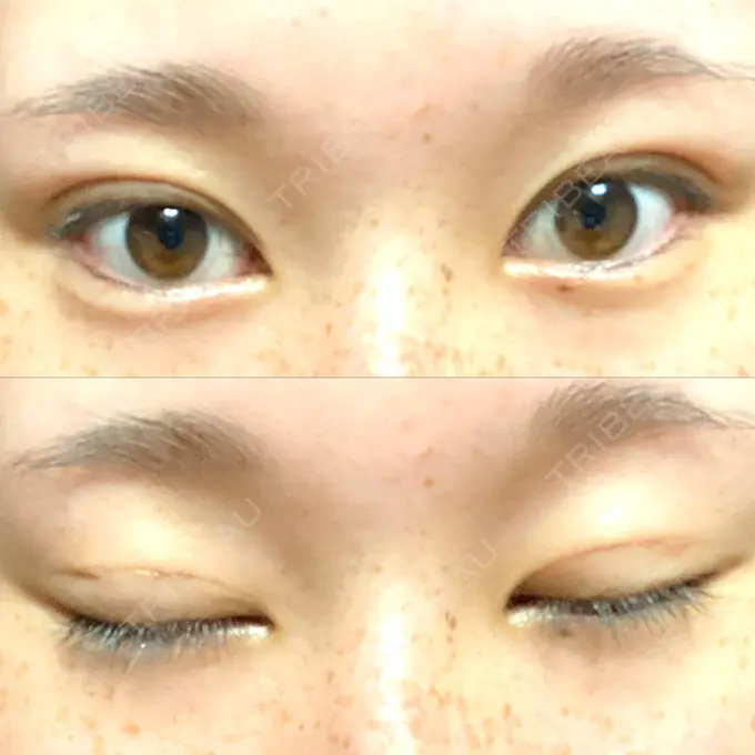 二重埋没 フェアクリニック川口 DAY 25 メイン用