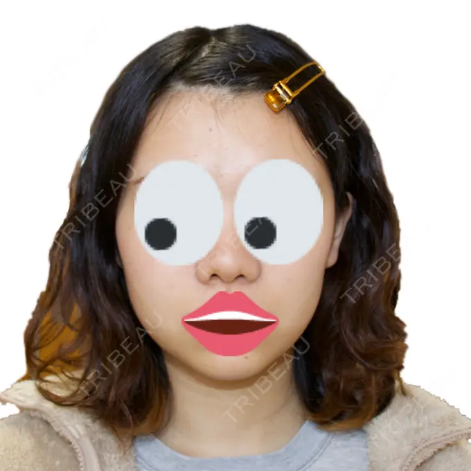 脂肪吸引（顔） みずほクリニック DAY 373 メイン用