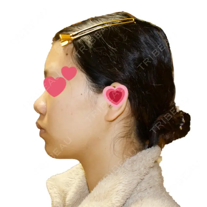 脂肪吸引（顔） みずほクリニック AFTER メイン用