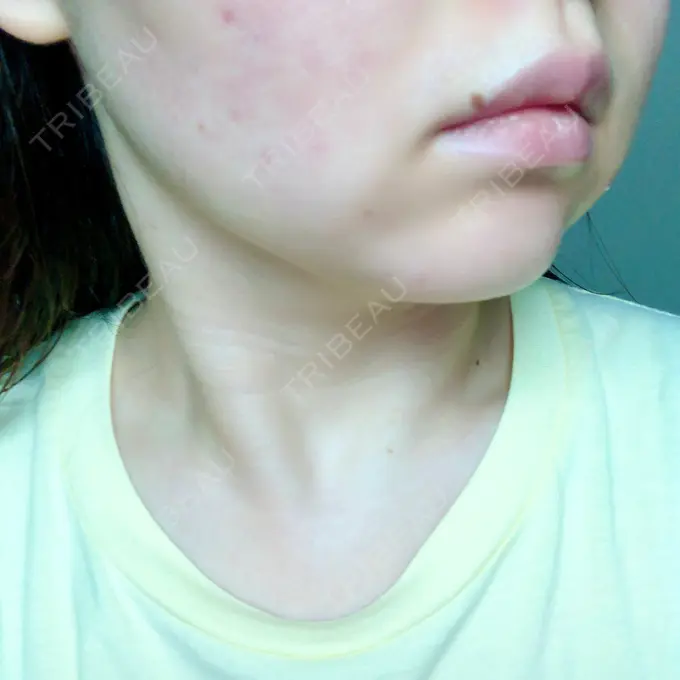 脂肪溶解注射（顔） 赤坂プレミアクリニック DAY 8 メイン用