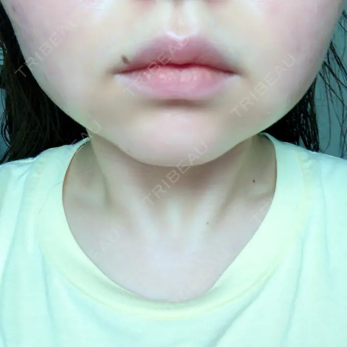 脂肪溶解注射（顔） 赤坂プレミアクリニック DAY 8 メイン用