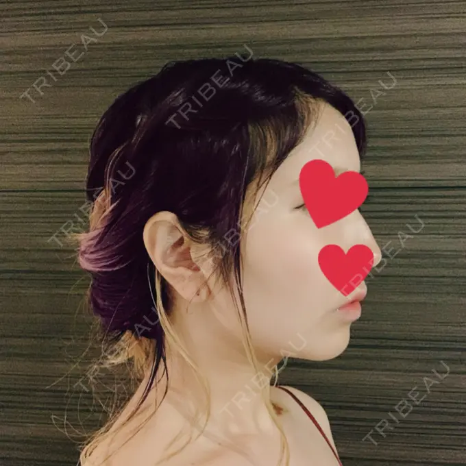 糸リフト / バッカルファット除去 / 脂肪吸引（顔） / メーラーファット除去 / ボトックス（あご） WOM CLINIC GINZA （ワム クリニック ギンザ） DAY 35 メイン用