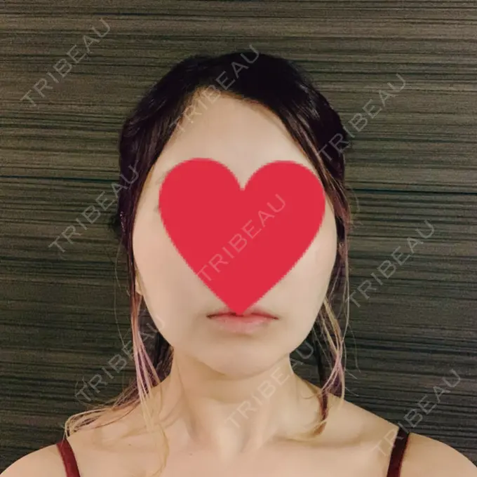 糸リフト / バッカルファット除去 / 脂肪吸引（顔） / メーラーファット除去 / ボトックス（あご） WOM CLINIC GINZA （ワム クリニック ギンザ） DAY 35 メイン用