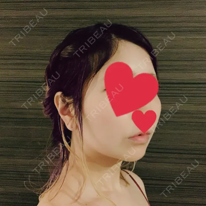 糸リフト / バッカルファット除去 / 脂肪吸引（顔） / メーラーファット除去 / ボトックス（あご） WOM CLINIC GINZA （ワム クリニック ギンザ） DAY 35 メイン用